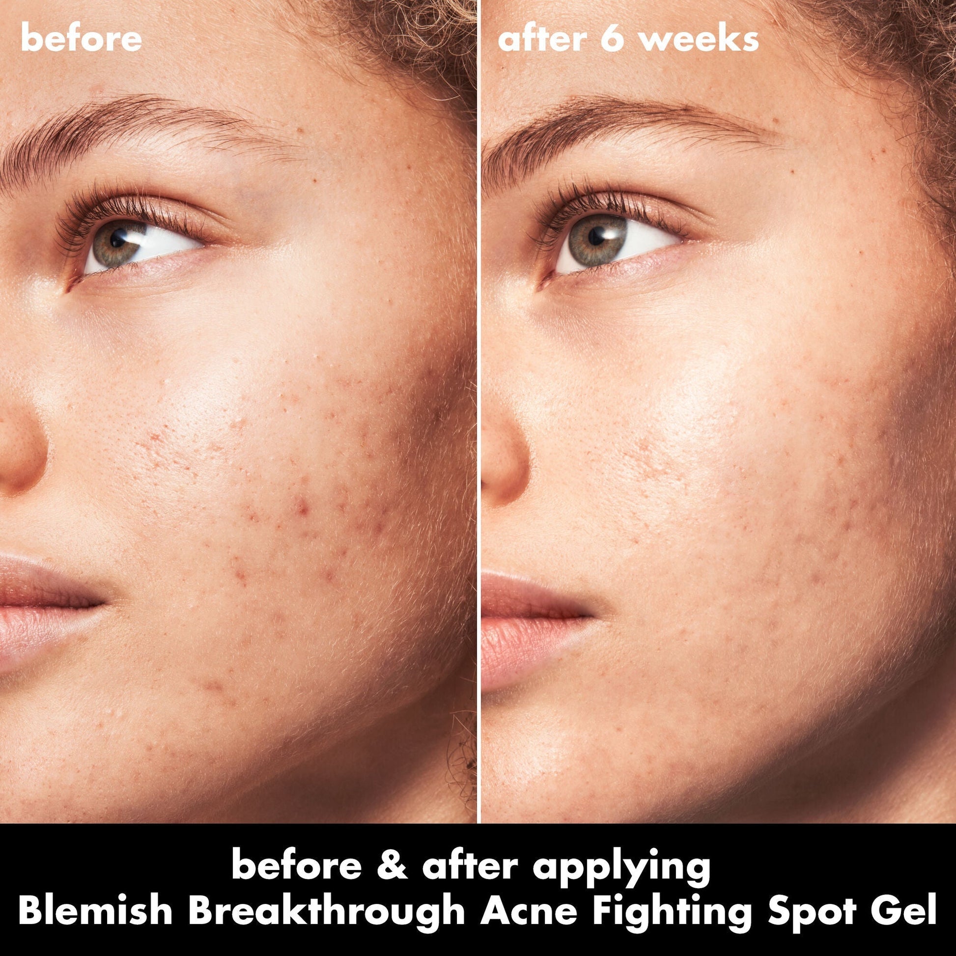 blemish-breakthrough-acne-fighting-spot-gel-j4 0326_EDU_BB_SpotGel_BA_MARLEY.jpg