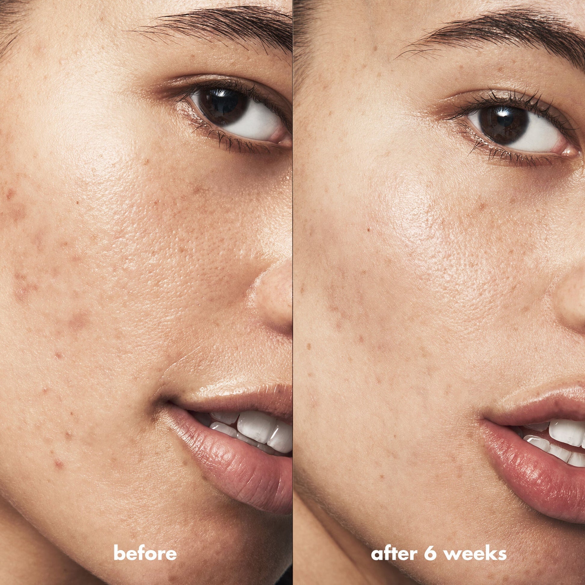 blemish-breakthrough-acne-calming-water-cream-mini-p0 Acne_PDP_Isabella_Before_After_f0d452cd-72f5-4bb8-a6df-0b3cc23143ef.jpg