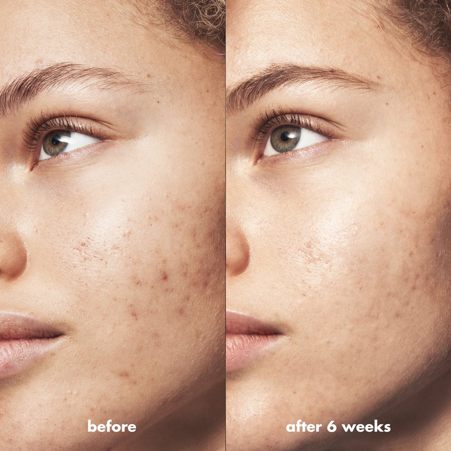 blemish-breakthrough-acne-calming-water-cream-mini-p0 Acne_PDP_Marley_Before_After_acf01478-a58b-47ce-99b5-2ef1dc022f9b.jpg